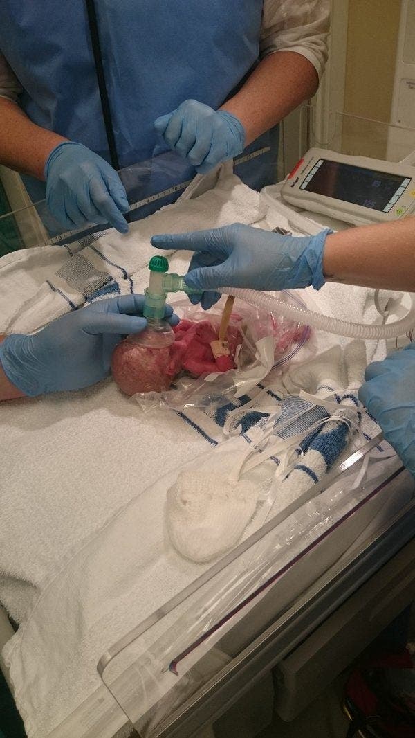 Les médecins ne pensent pas que ce bébé prématuré va survivre alors ils le place dans un sac à sandwich