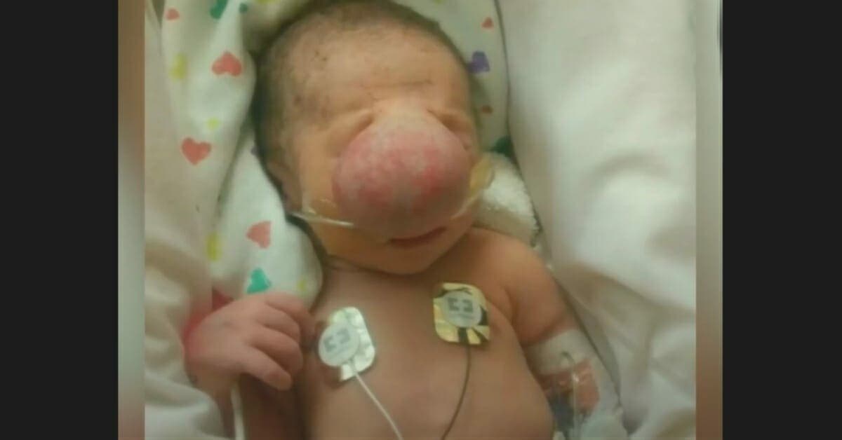 Les médecins ôtent ceci du visage de ce bébé