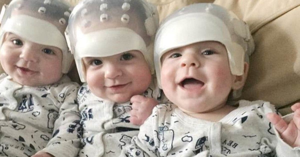 Les médecins soignent la tête de triplés nés avec une maladie rare