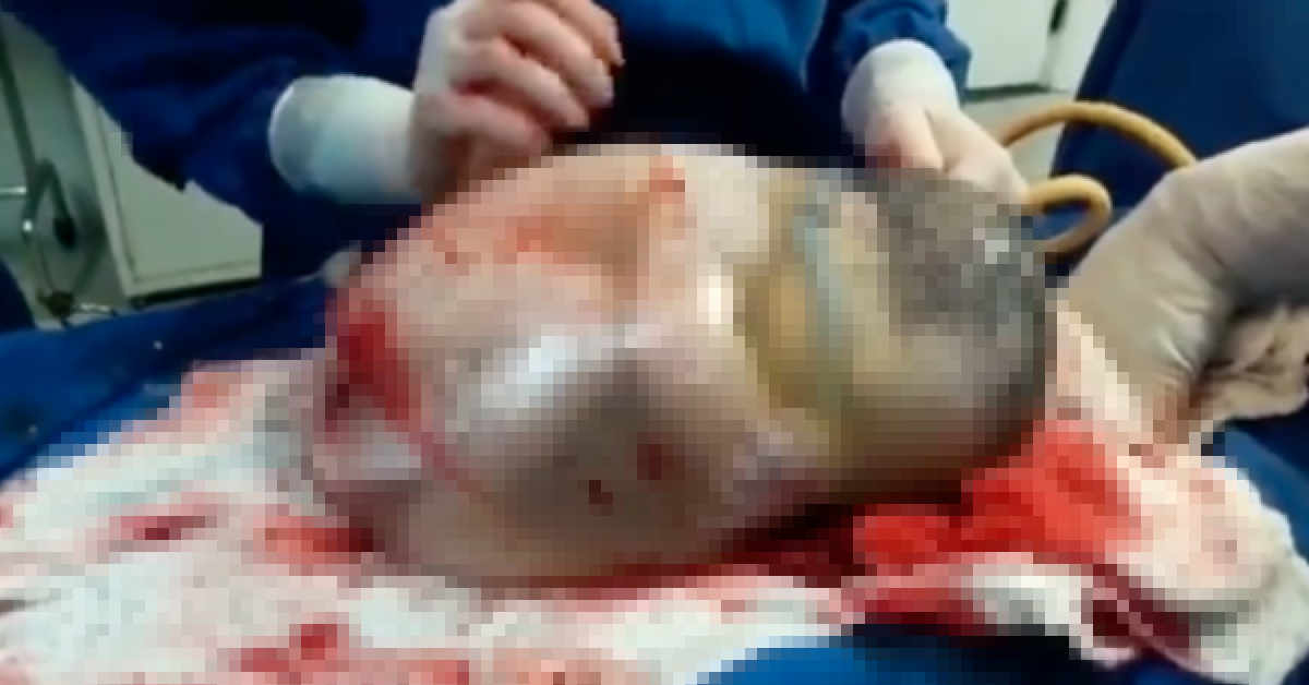 La naissance incroyable d’un bébé dans son sac amniotique (vidéo)