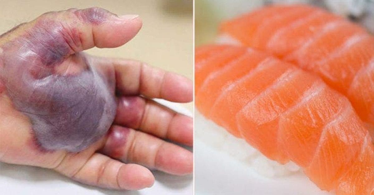 Les médecins sont forcés d’amputer le bras d’un homme après qu’il est mangé des sushis
