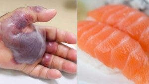 Les médecins sont forcés d’amputer le bras d’un homme après qu’il est mangé des sushis