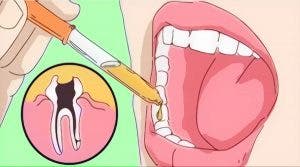 blanchir les dents