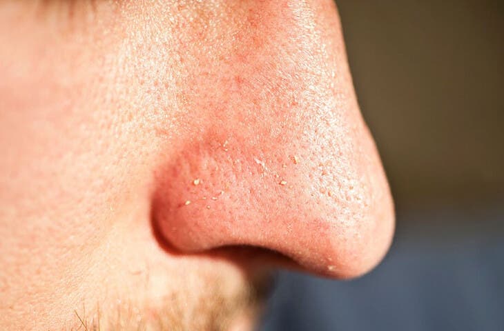 Blackheads can sometimes be caused by pollution.