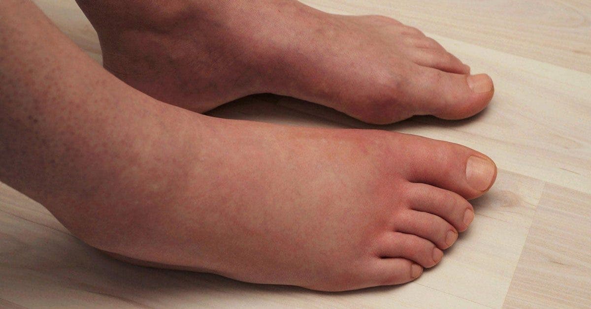 Les scientifiques expliquent 6 choses qui causent des jambes enflées