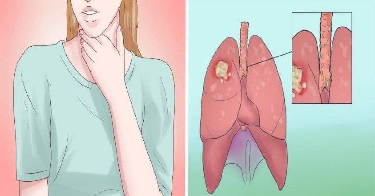 Les symptômes du cancer du poumon que vous devez connaître