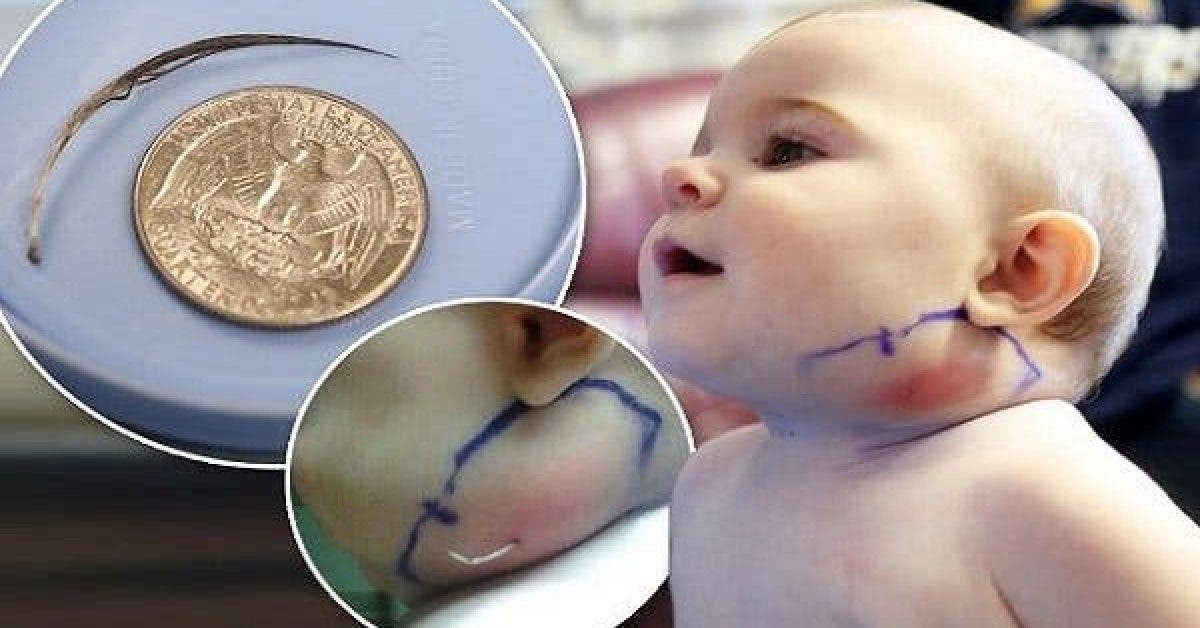 Mother Saw Something Strange On Her Babys Neck. What Actually Came Out Is Shocking. All Parents Should See This 2