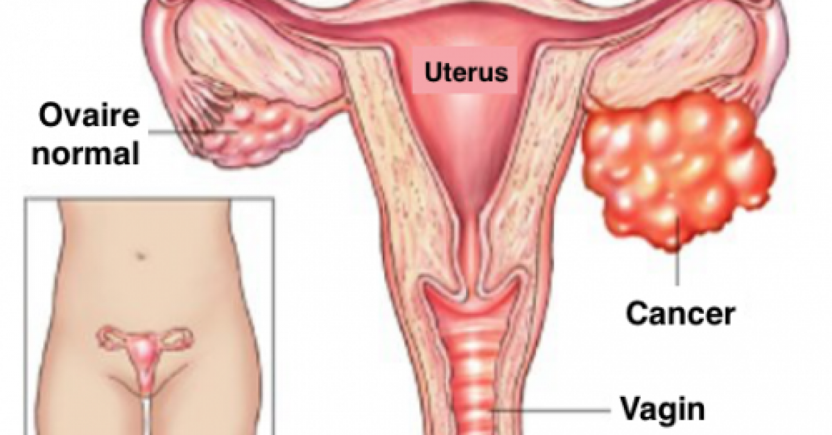 Ne prenez pas à la légère ces symptômes du cancer de l’ovaire