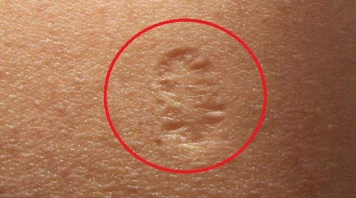 Nous avons tous cette petite cicatrice sur le bras