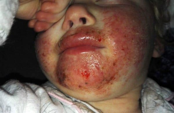 Personne ne comprend pourquoi sa fille a des inflammations sur son visage