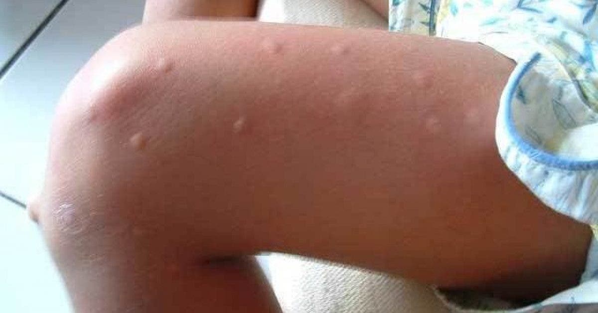 Pourquoi certaines personnes sont toujours mordues par les moustiques alors que dautres ne le sont pas 1