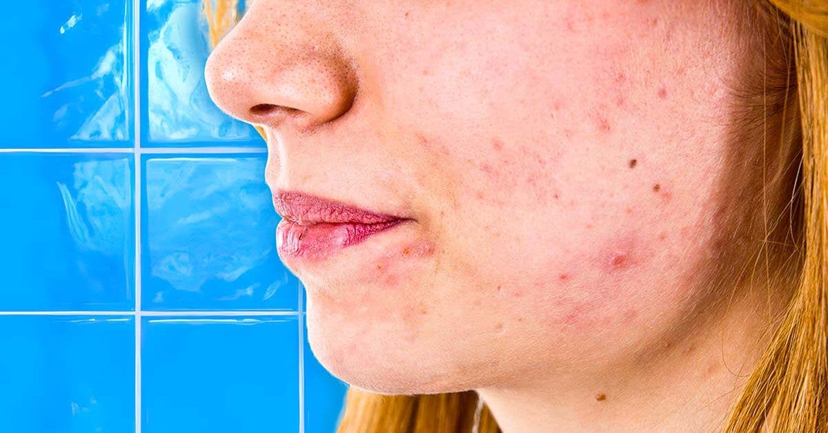 Quels sont les réflexes à adopter contre l’acné ?