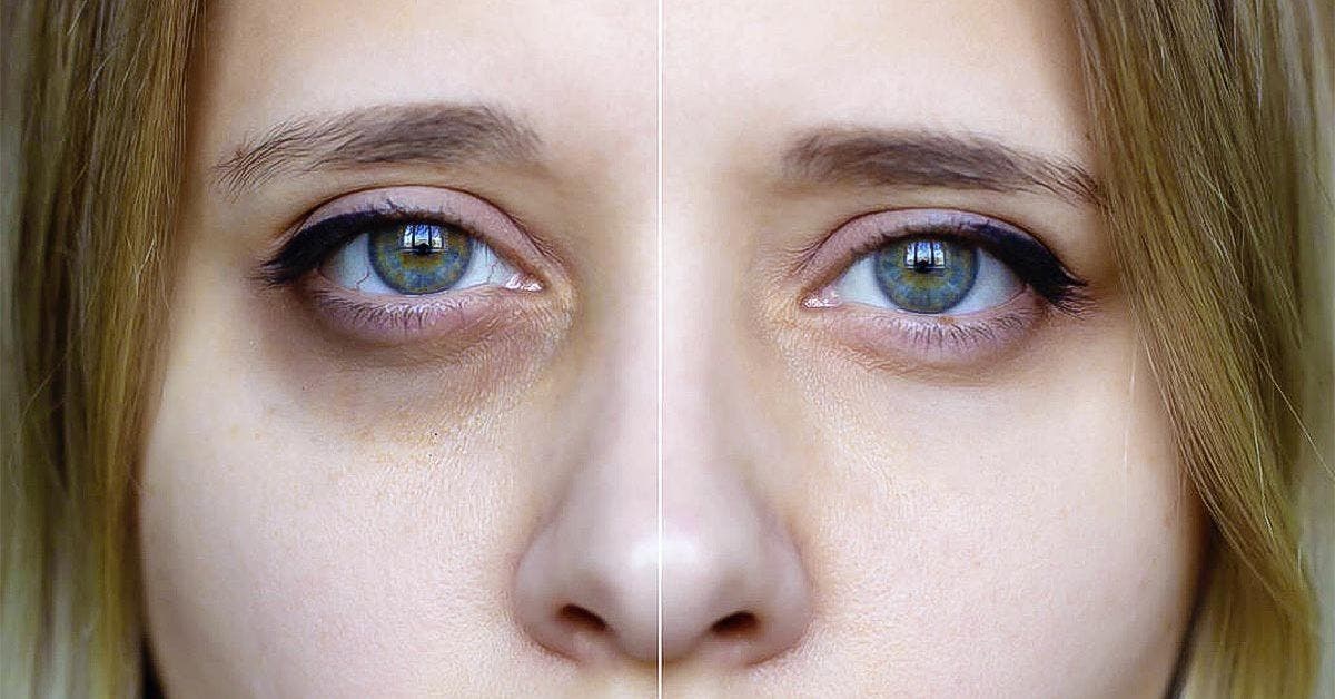 Se débarrasser des cernes et rajeunir le contour des yeux sans maquillage