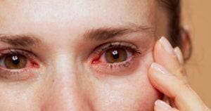 Sécheresse oculaire conseils pour soulager les yeux secs