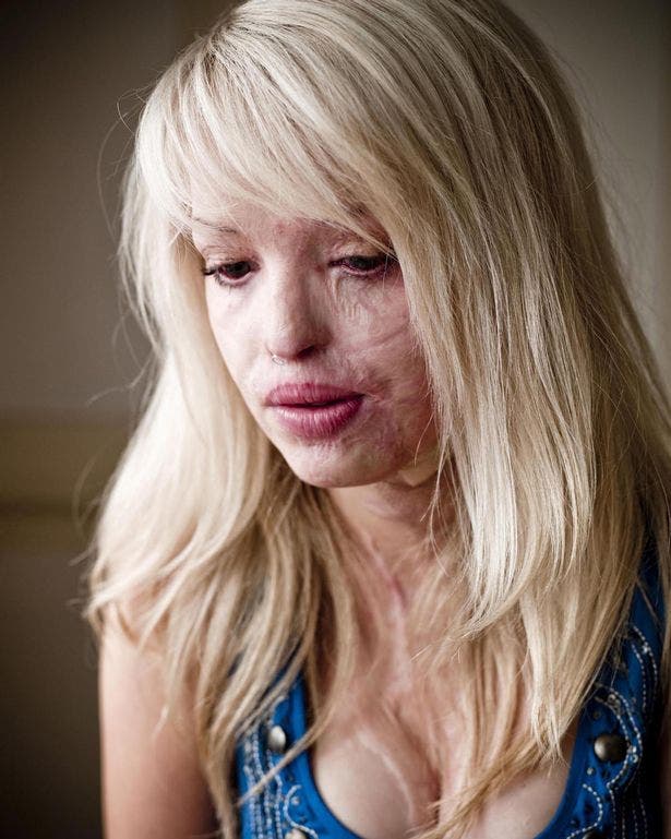 Son ex l’avait violée et lui a jeté de l’acide sur son visage