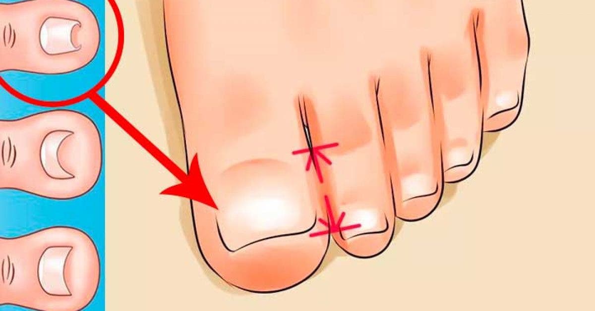 Traiter votre ongle incarné facilement et naturellement sans passer par une intervention chirurgicale