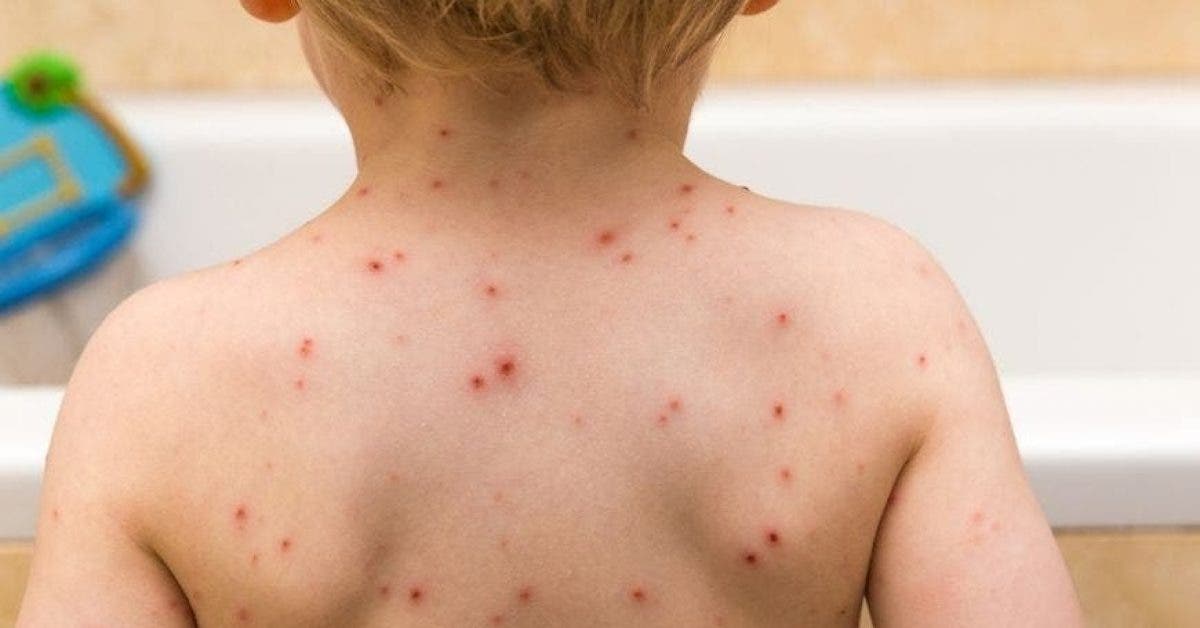 Un bébé subit un AVC à cause de ses frères non vaccinés contre la varicelle