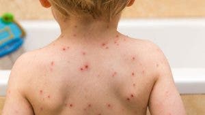 Un bébé subit un AVC à cause de ses frères non vaccinés contre la varicelle