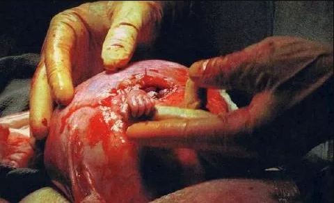 Un fœtus