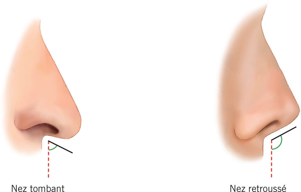 Un nez retroussé
