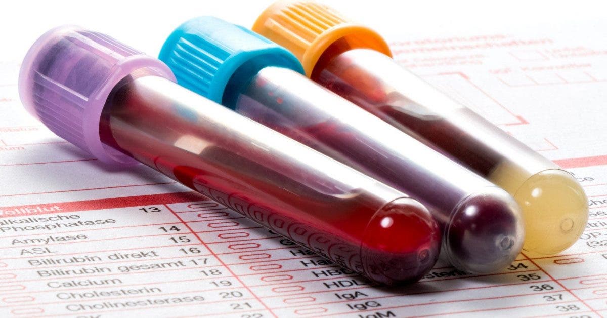Un nouveau test sanguin pour la fibromyalgie offre de l'espoir à des millions de personnes souffrant de douleurs chroniques