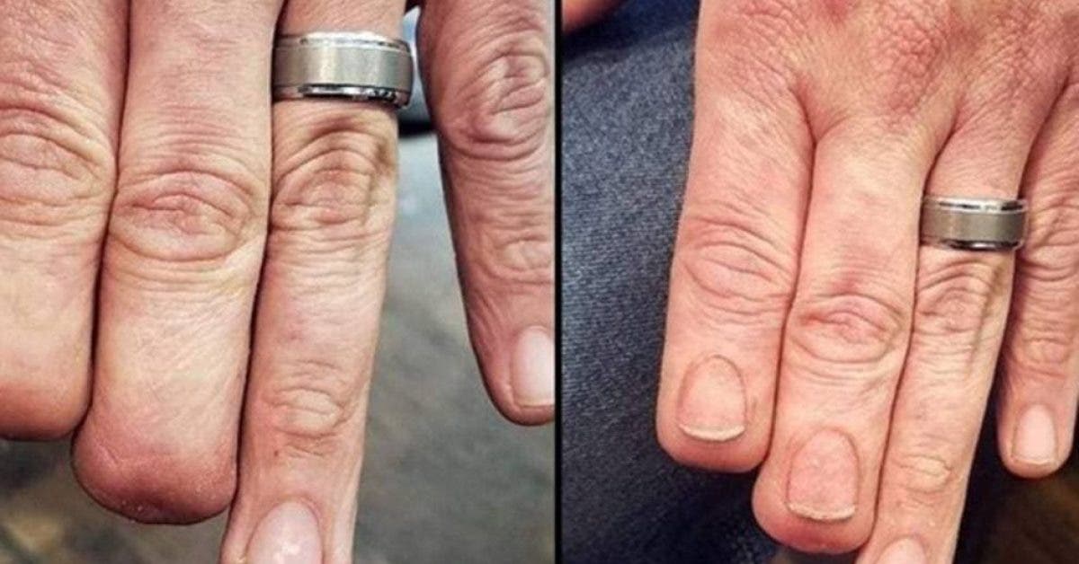 Un tatoueur restaure des ongles sur un homme qui a perdu deux doigts