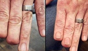 Un tatoueur restaure des ongles sur un homme qui a perdu deux doigts