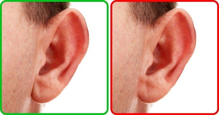 Une asymetrie des oreilles 1 1