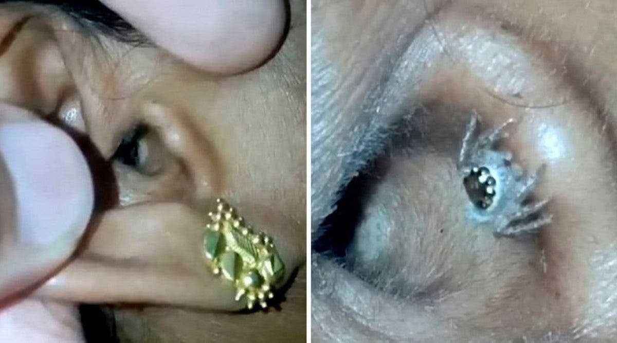 Une femme découvre que ses maux de tête sont causés par une araignée vivant dans son oreille