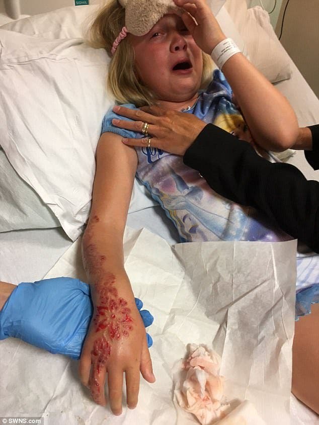 Une fillette de 7 ans souffre de brulures chimiques causees par un soin de beaute a la mode 1 1