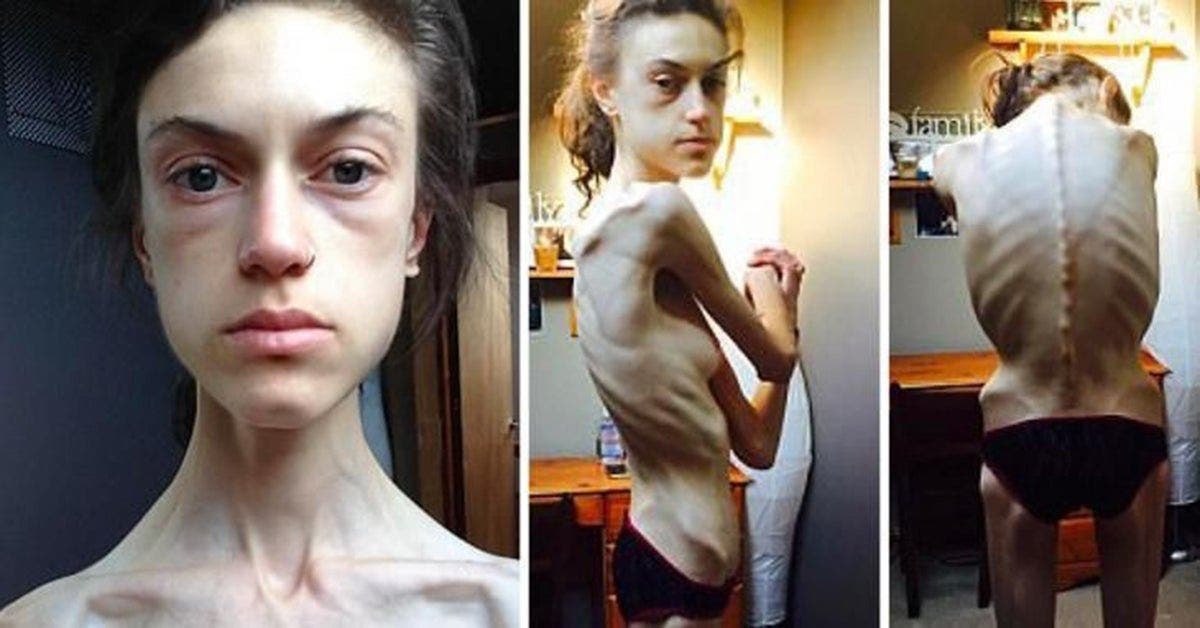 Cetosis anorexia