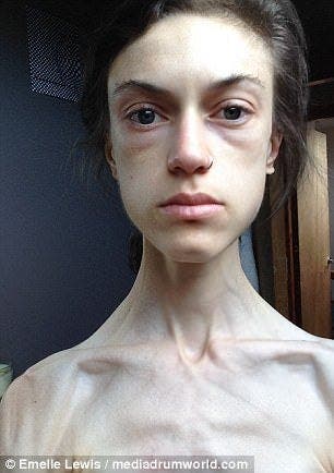 Une jeune fille anorexique montre des photos avant et après sa guérison et elle est devenue très jolie