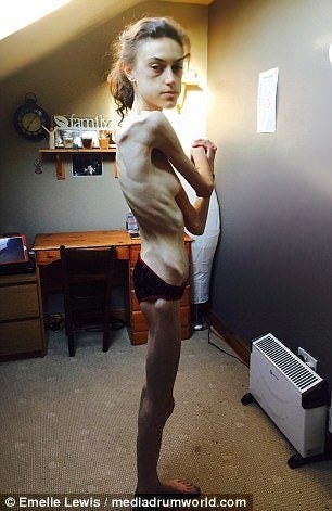 Une jeune fille anorexique montre des photos avant et après sa guérison et elle est devenue très jolie