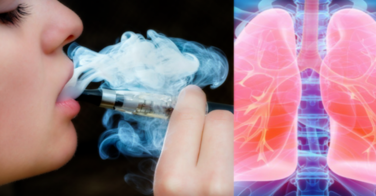 Une jeune fille developpe un grave probleme aux poumons apres 3 semaines de cigarette electronique 1