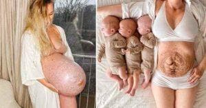 Une maman de triplés partage ses photos avant et après l’accouchement pour rendre hommage aux femmes enceinte