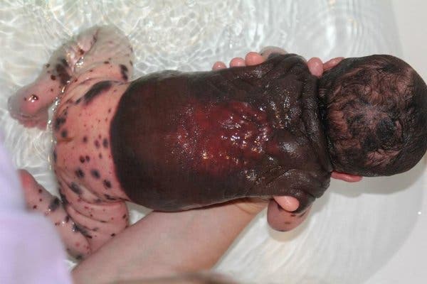 Une maman est choquée quand elle voit son fils à la naissance avec des taches noires
