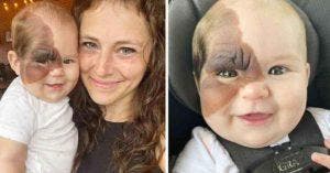 Une mère souhaite montrer à sa fille de 13 mois, qui a une tache de naissance rare, sa beauté unique
