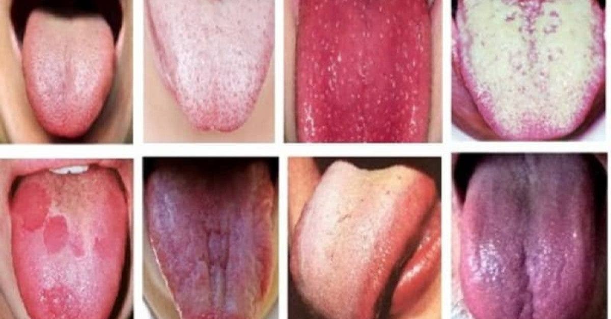 Voici ce que la couleur de votre langue révèle sur la santé