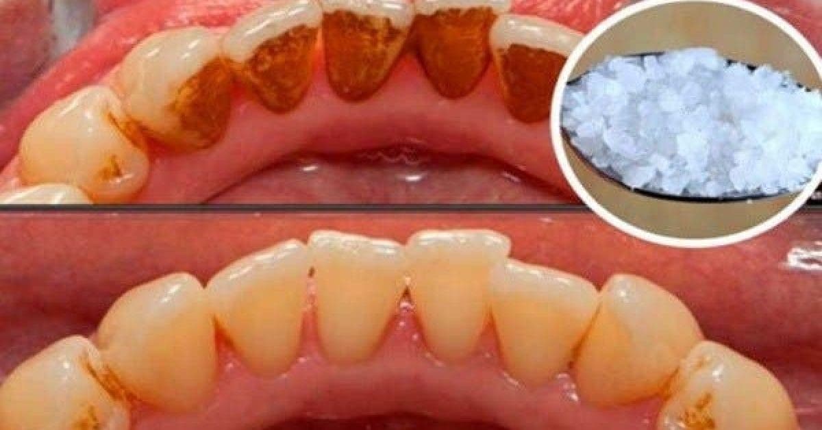 Voici comment blanchir des dents extremement jaunes et supprimer les plaques de tartre incrustees