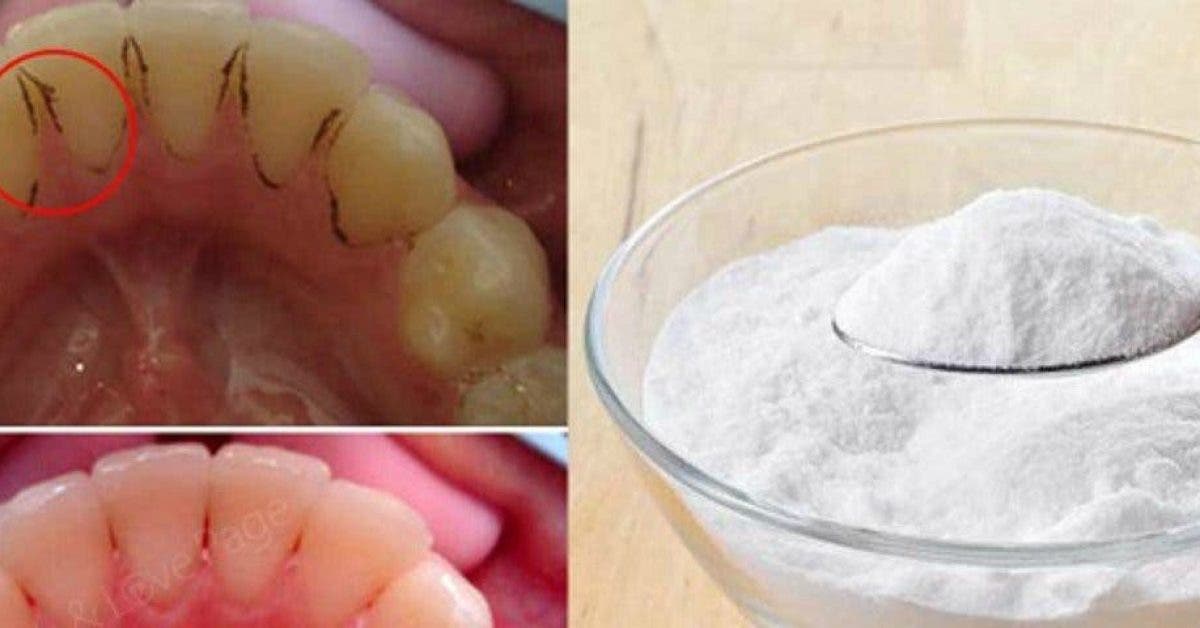 Voici comment blanchir les dents jaunes