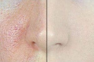 Voici comment faire disparaitre rapidement les pores dilates et avoir une peau parfaite 1