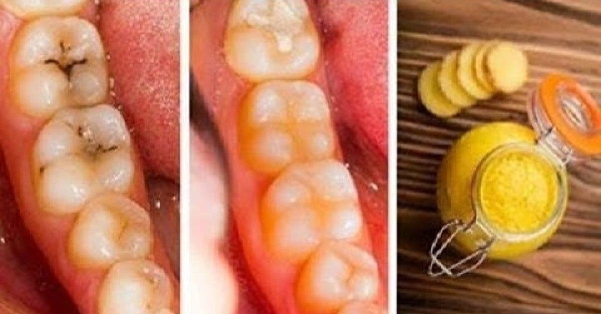 Voici comment guérir les caries et la dégradation des dents naturellement et facilement à la maison