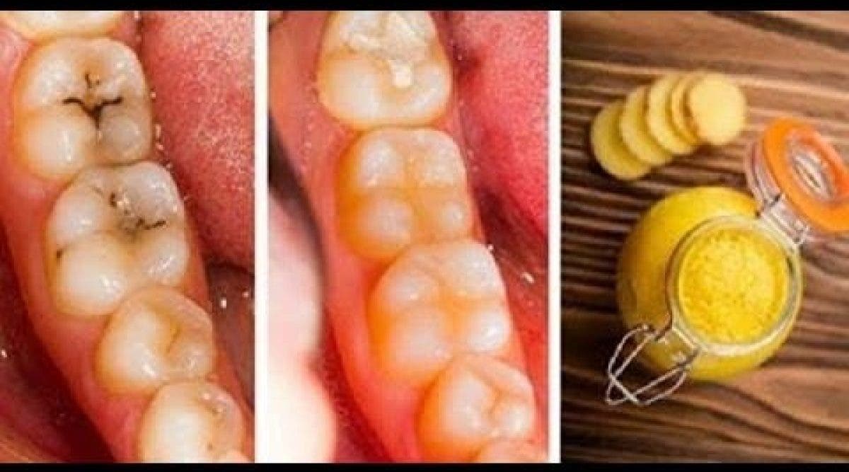 Voici comment guérir les caries et la dégradation des dents naturellement et facilement à la maison