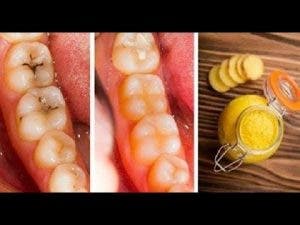 Voici comment guérir les caries et la dégradation des dents naturellement et facilement à la maison