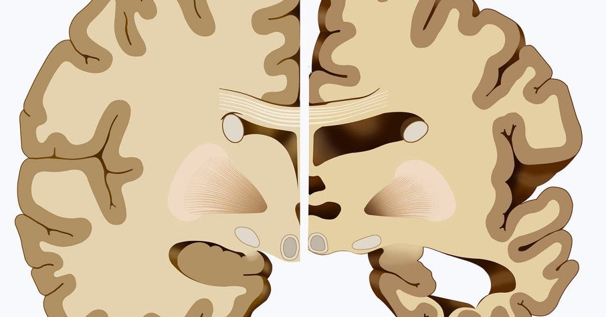 Voici comment protéger votre cerveau d’Alzheimer