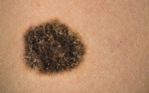Voici comment reconnaitre un cancer de la peau
