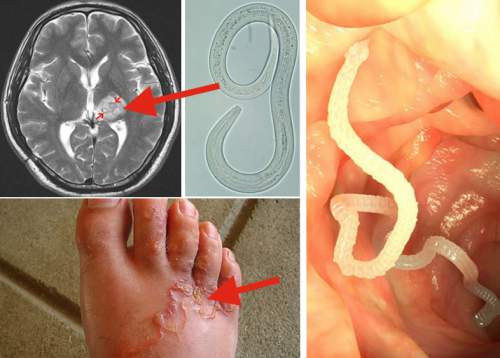 Here's how to kill all the parasites in your body quickly and easily