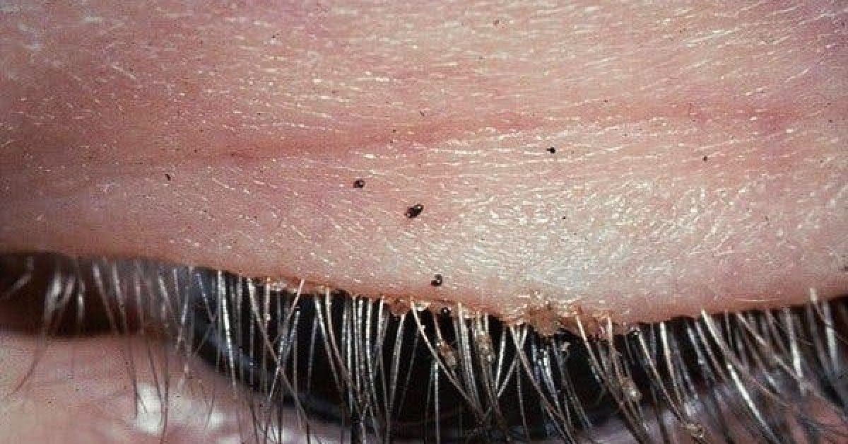 What This Doctor Found On The Lashes Of This Woman Will Shock You 1 1 1