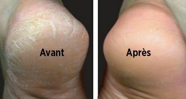 Astuce naturelle pour traiter les pieds secs et fendillés Astuce naturelle pour traiter les pieds secs et fendillés