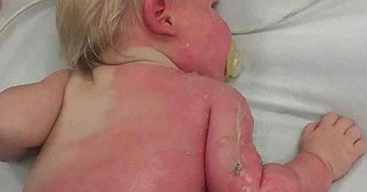 Une maman lance un avertissement après que son bébé ait été brûlé au deuxième degré